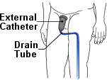 Shop Catheters Now